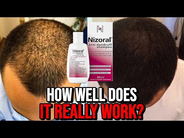 Ketoconazole Shampoo for Hair Growth - How Well Does it REALLY Work?