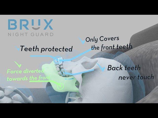 Why Choose Brux Night Guard for Teeth Grinding and Clenching?