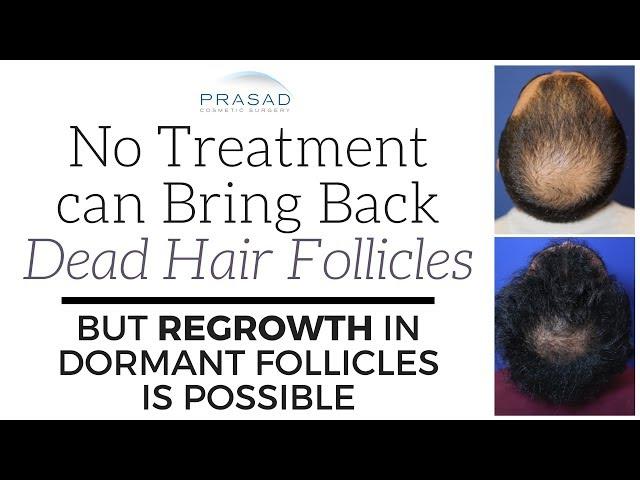 Why No Treatment can Revive Dead Hair Follicles, but Regrowth of Dormant Follicles is Possible