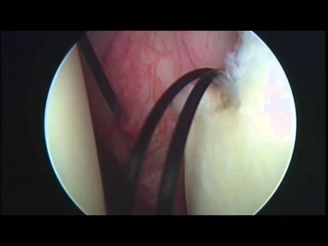 Arthroscopic HAGL repair