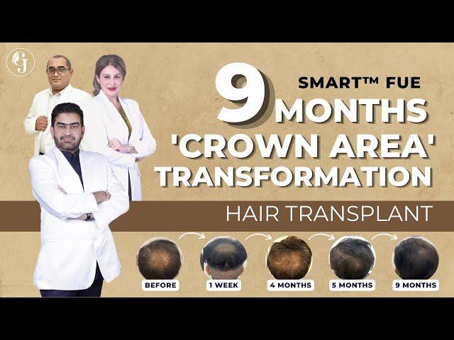 9-Month Journey After SMART™ FUE | GLOJAS AESTHETIC CLINIC