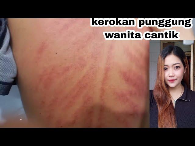 Kerokan punggung wanita terbaru || Pertolongan pertama masuk angin obat tradisional