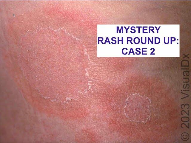 Another Mystery Rash! Use the Skin Exam to Make a Diagnosis!