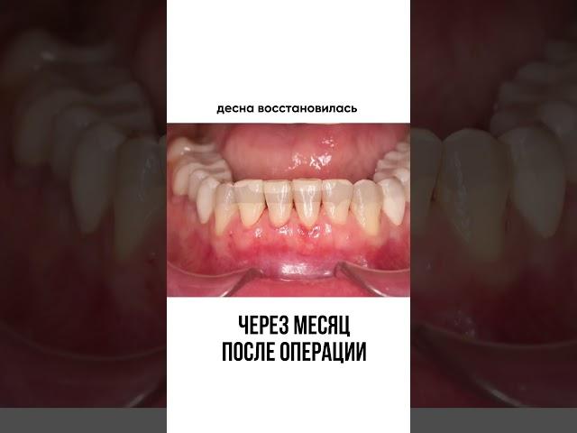 лечение рецессии десны позволяет вернуть молодой вид и продлить срок службы зубов на десятки лет