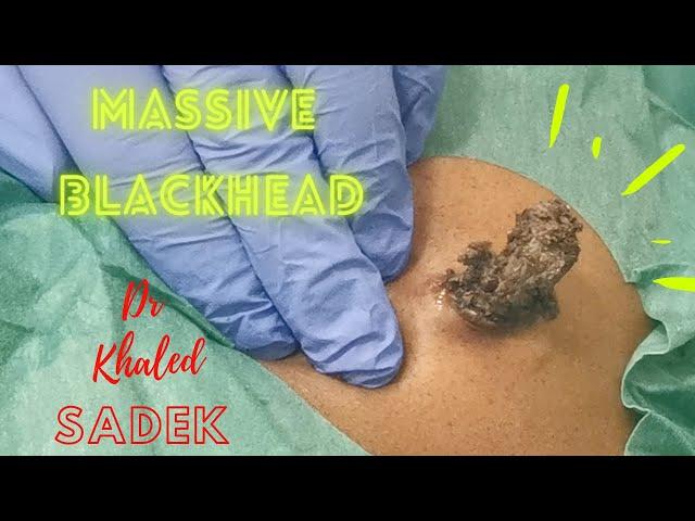 Massive 15 year Blackhead. Dr Khaled Sadek. LipomaCyst.com