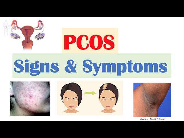 Polycystic Ovary Syndrome (PCOS) Signs & Symptoms | & Why They Occur