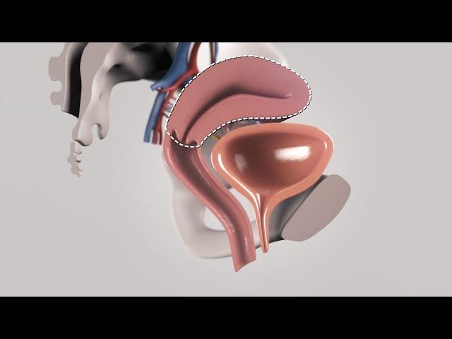 Total laparoscopic hysterectomy