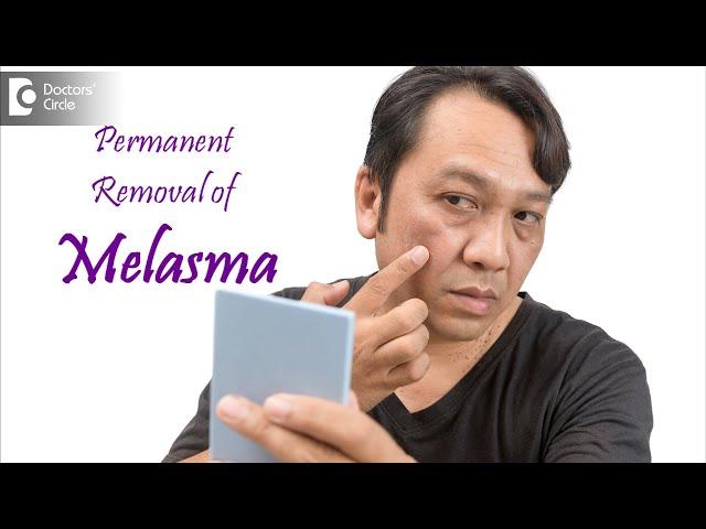 Can melasma be removed permanently? - Dr. Sahebgowda Shetty | Doctors' Circle