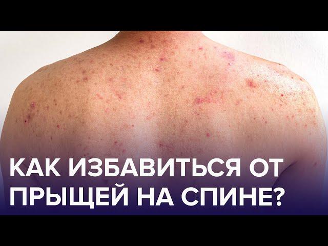 Из-за чего появляются ПРЫЩИ на спине? Как от них избавиться? | Доктор 24