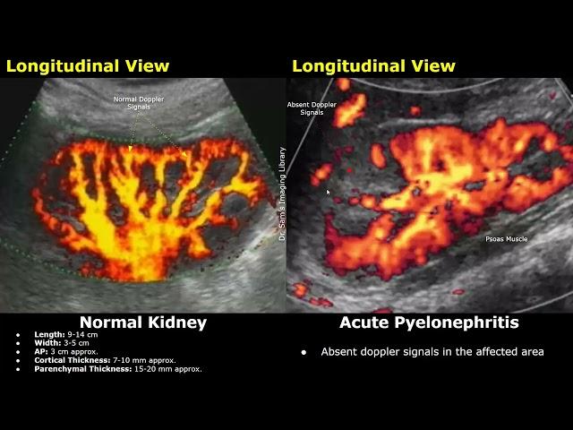 Kidney Ultrasound Normal Vs Pyelonephritis Imaging Findings | Acute, Chronic & Emphysematous Types