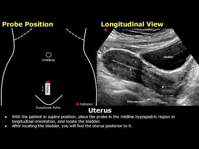 Uterus & Ovaries Ultrasound Probe Positioning | Transducer Placement | Gynecological USG Scanning