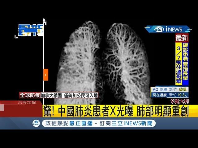 中國肺炎患者X光照片曝光肺部明顯重創！ 義大利報紙訃聞"整整10頁"｜記者 程思瑋｜【國際局勢。先知道】20200318｜三立iNEWS