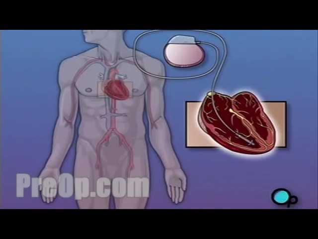 Permanent Pacemaker Implant Surgery PreOp® Patient Education