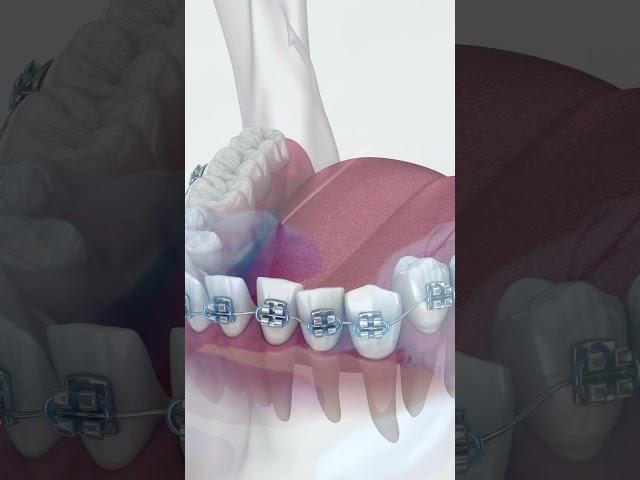 Types Of Braces Wires | NITI Wires