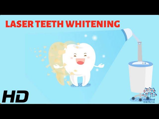Laser Teeth Whitening: The Safe and Effective Way to Whiten Your Teeth