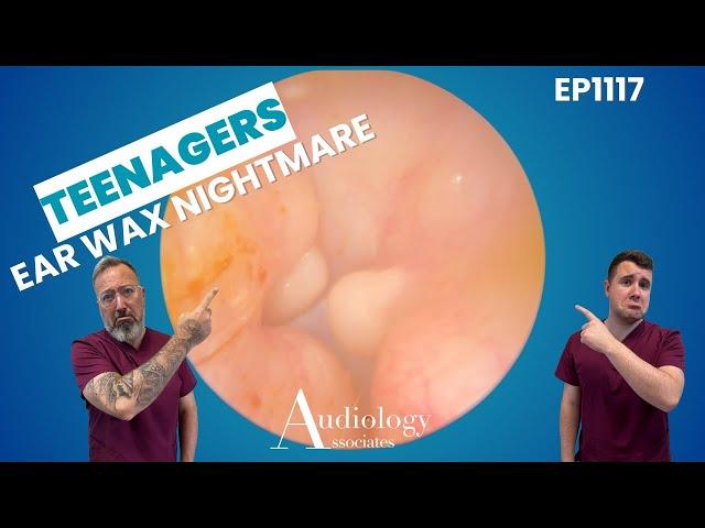 Teen’s Ear Wax Nightmare! Thick, Sticky & Deeply Stuck   EP1117