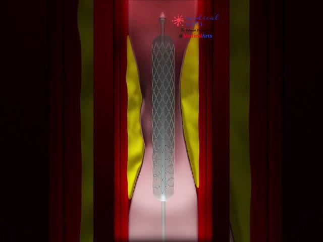 Heart Attack Treatment || HEART STENT ||  Angioplasty ||- PCI