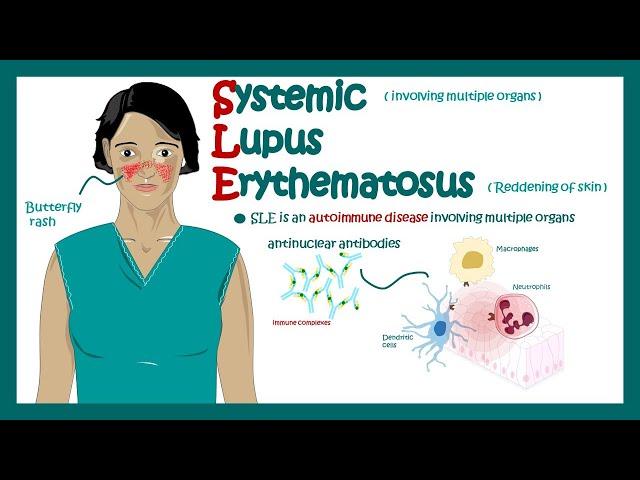 Systemic Lupus Erythematosus | signs and symptoms, pathophysiology, and diagnosis of Systemic Lupus