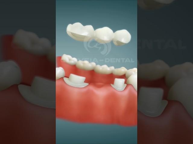 {Use earphone} Dental Bridge [Porcelain] Procedure after extraction  #satisfying