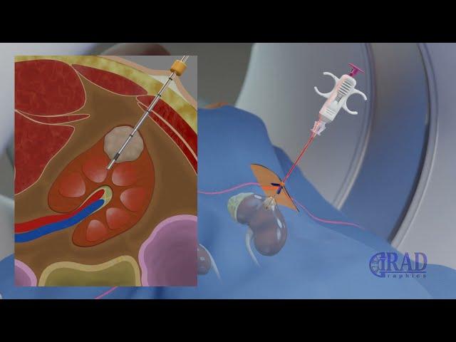 Renal Mass Biopsy (CT guided Kidney Tumor Biopsy)