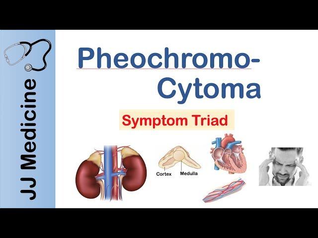 Pheochromocytoma | Symptoms and Treatment