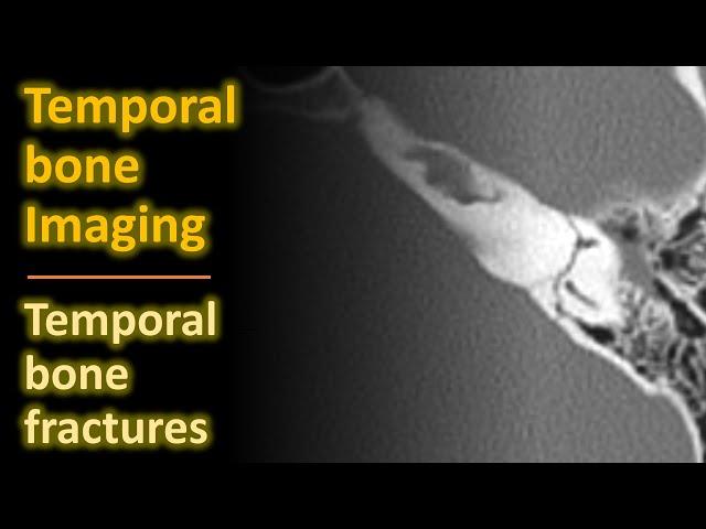 Temporal Bone Imaging - Temporal Bone Fractures