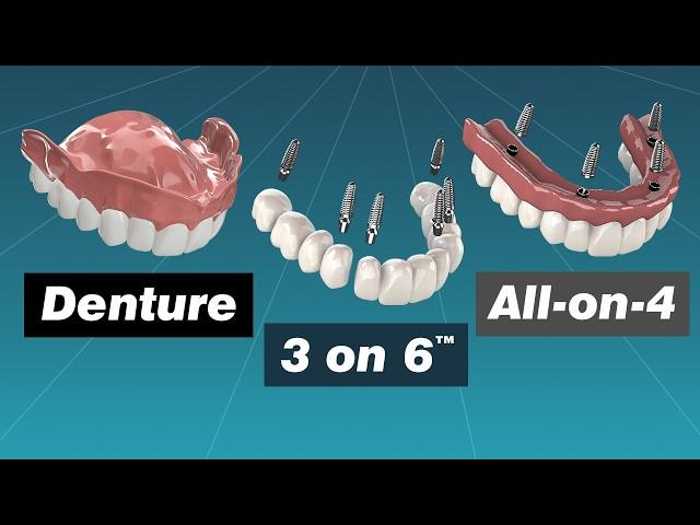 Alternative to Dentures: Comparing Dentures, Overdentures, All-on-4 and 3 on 6™