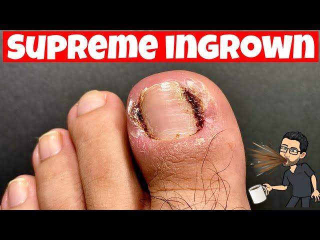 INFECTED INGROWN TOENAIL SATISFYING REMOVAL