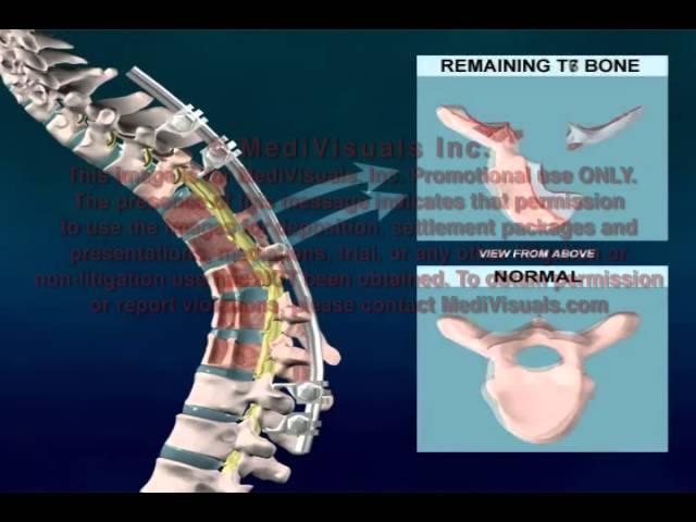 Spinal Surgery – Kyphosis