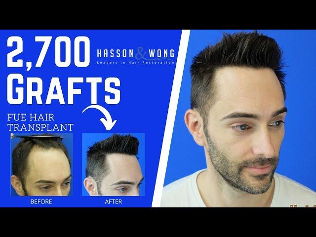 Hasson and Wong Testimonial | Before and After Hair Transplant