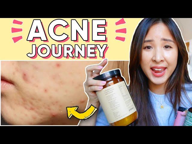 How I Used Food, Supplements & Nutrition to CLEAR My Acne, NATURALLY 