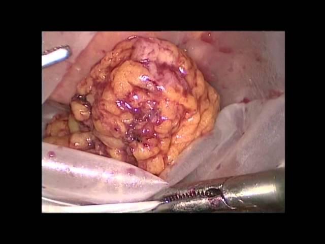 Laparoscopic Cystoprostatectomy & Pelvic Lymphadenectomy