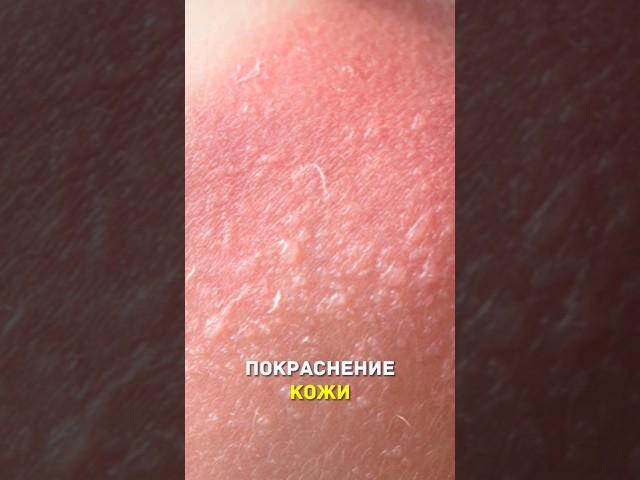Просто о солнечных ожогах #shorts