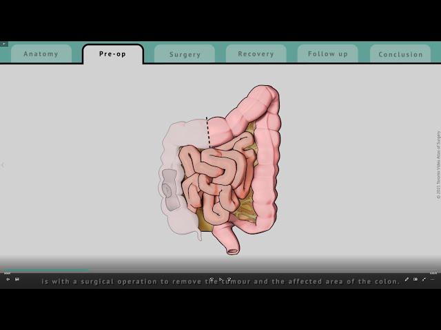 Right Hemicolectomy explained | What patients can expect | TVASurg