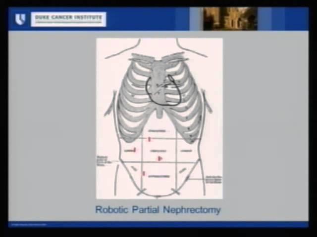 Recovery After Nephrectomy Ed Rampersaud, M.D.