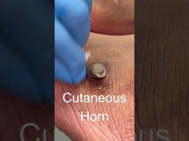 Cutaneous horn watch the removal on my channel! #cutaneoushorn #feet #podiatry #footcare