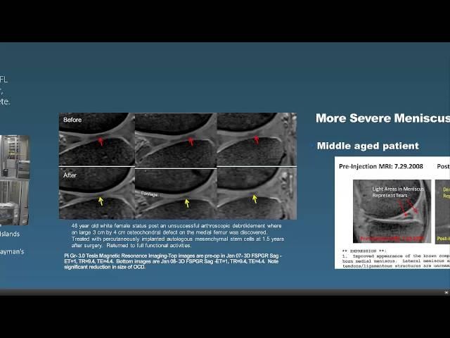 Regenexx Stem Cell Procedure Overview Webinar with Dr Centeno