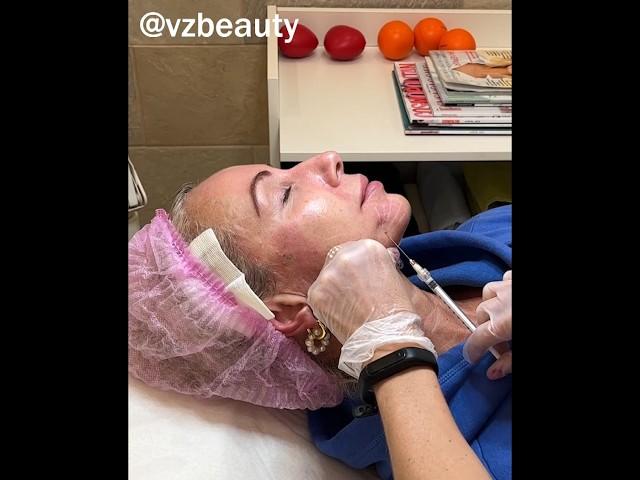 Векторный лифтинг препаратом Радиесс #beauty #радиесс