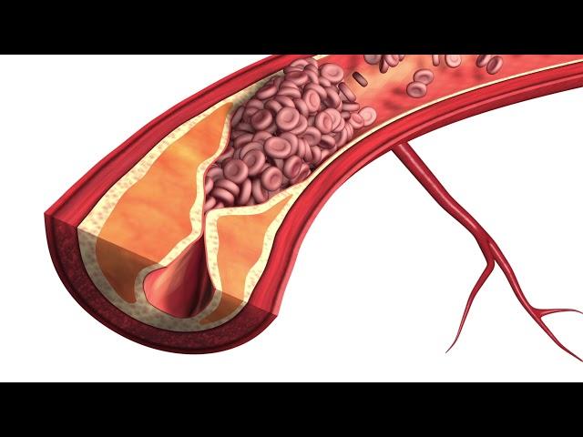 Atherosclerosis - Plaque Animation Model