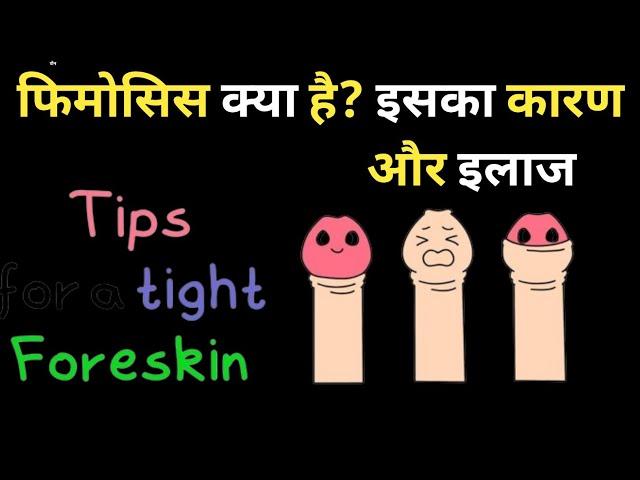 How to Deal with Phimosis? || Phimosis Symptoms and Treatment in Hindi