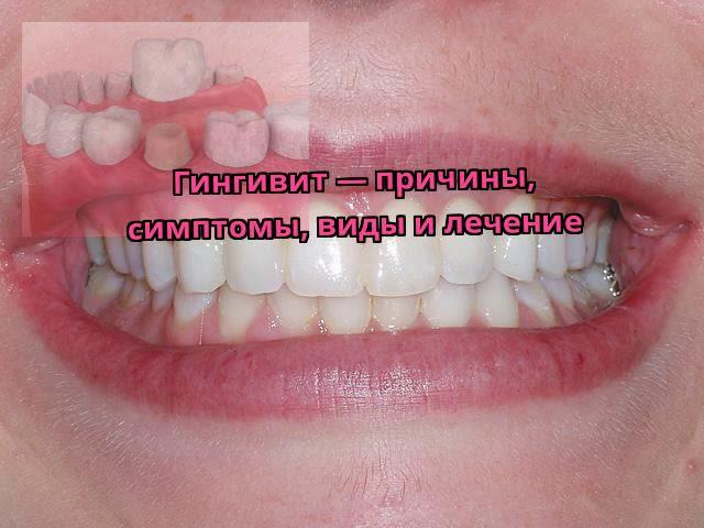 Гингивит — причины, симптомы, виды и лечение