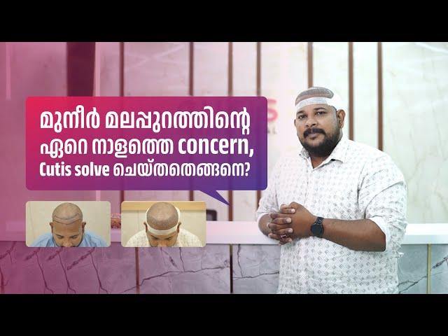 മുനീർ മലപ്പുറത്തിന്റെ ഏറെ നാളത്തെ concern, Cutis solve ചെയ്തതെങ്ങനെ? |  MUNEER MALAPPURAM