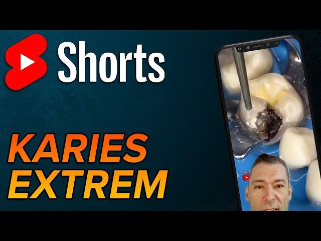 Massive Karies #shorts