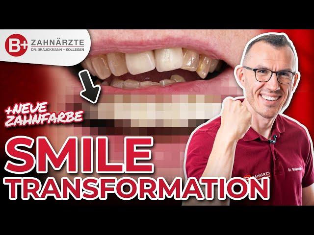 Smile Makeover mit Kronen - alte Zahnkronen raus, neues Lächeln rein!