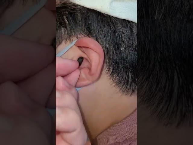 초소형 보청기 착용 모습
