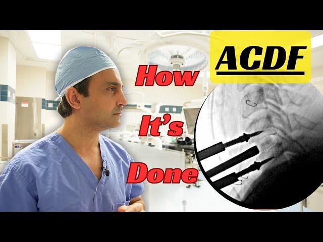 Anterior Cervical Diskectomy & Fusion (ACDF) surgery: Everything you need to know.