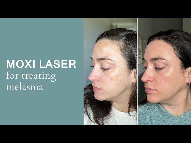 MOXI LASER FOR MELASMA