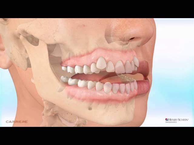 Carriere® Motion™ Appliance for Class III Correction - Patient Education Animation