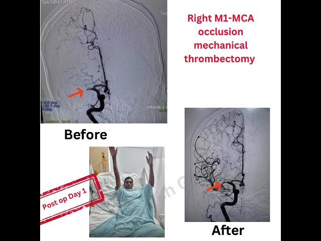 4 life-saving Mechanical Thrombectomies on patients with major brain strokes and paralysis