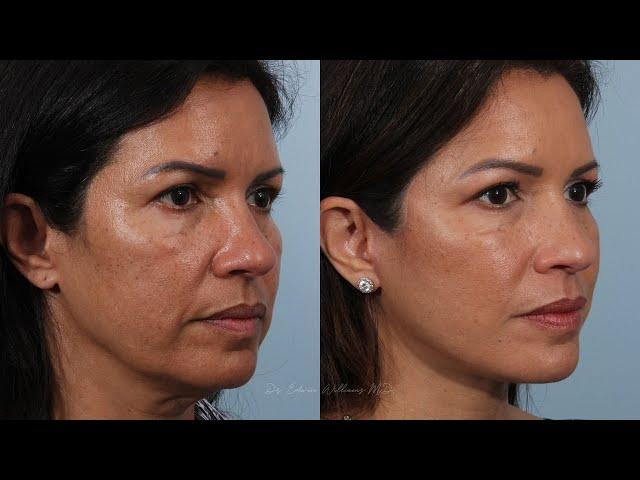 Day by Day Deep Plane Facelift Surgery Recovery